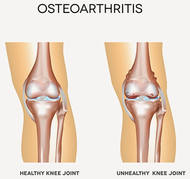 knee joint pictures osteoarthritis
