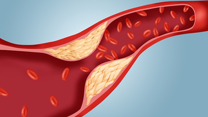 Tips to Lower Cholesterol: Risk Factors, Tips & More.
